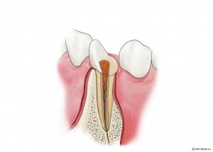 抜髄2　むし歯の除去